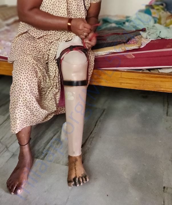 Plastic leg she is using as of now