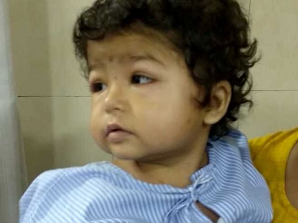 Help 2-year-Old Shraddha Fight Nephrotic Syndrome