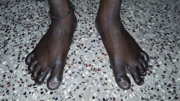 Affected foot