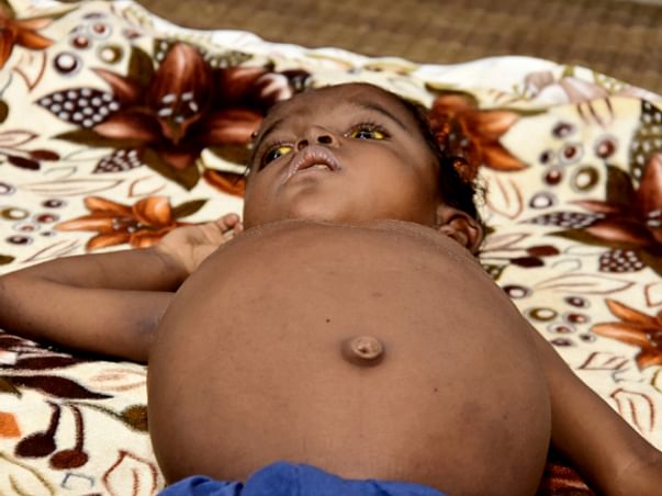Help Adil Undergo An Urgent Liver Transplant