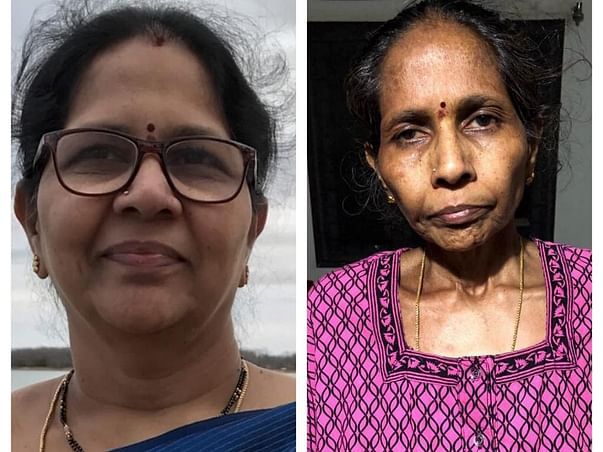 Help My Mother Under Go Liver Transplantation