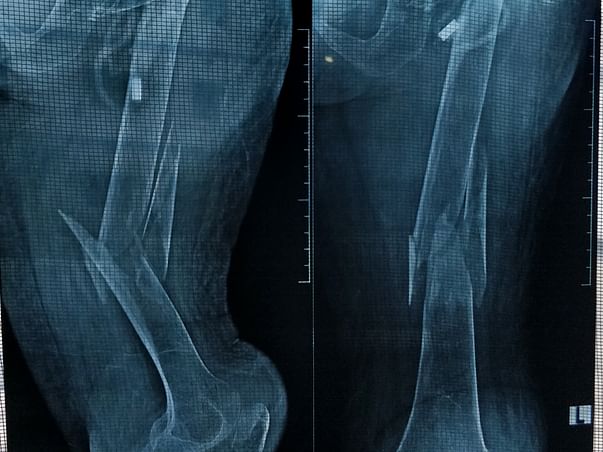 Help my grandmother for thighbone joint surgery