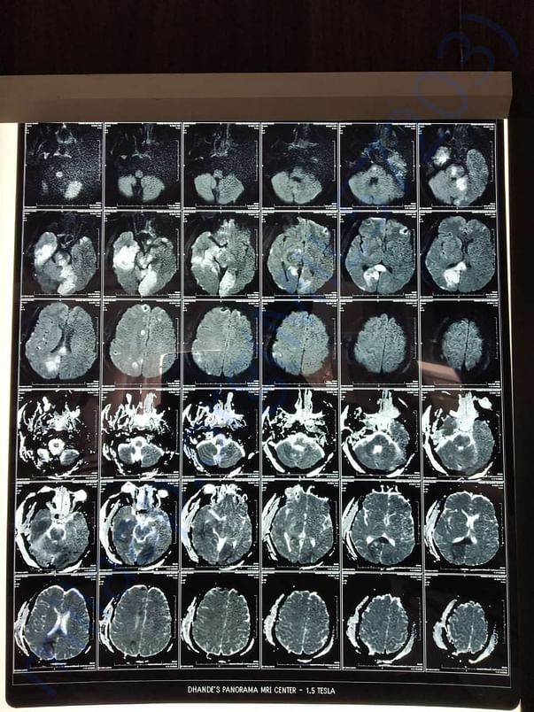 Brain MRI Report
