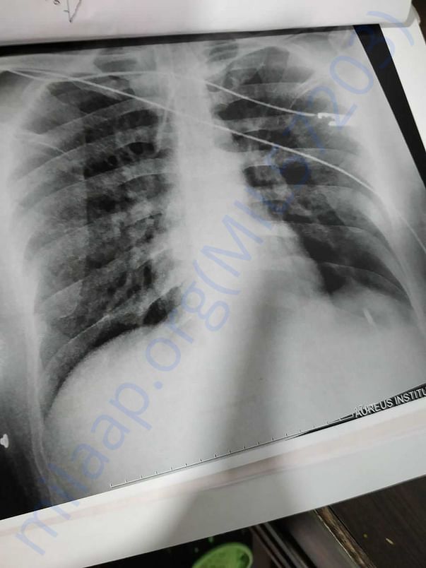 Xray