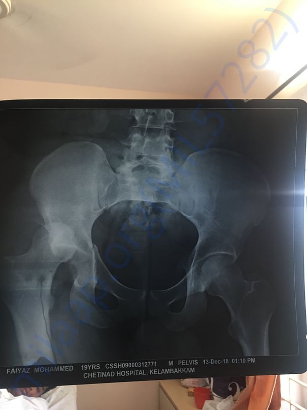 X ray