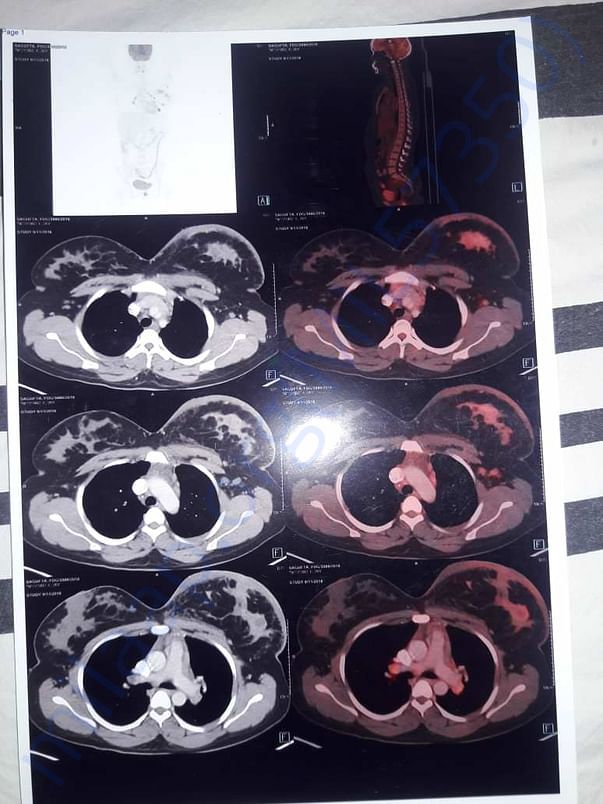 X-ray