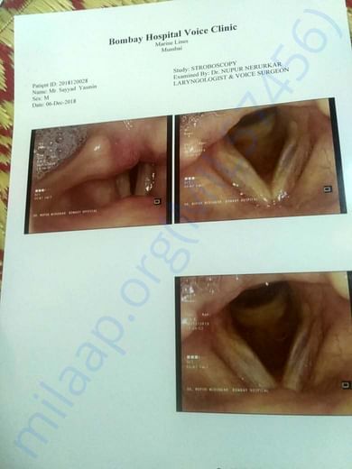 Vocal Chords