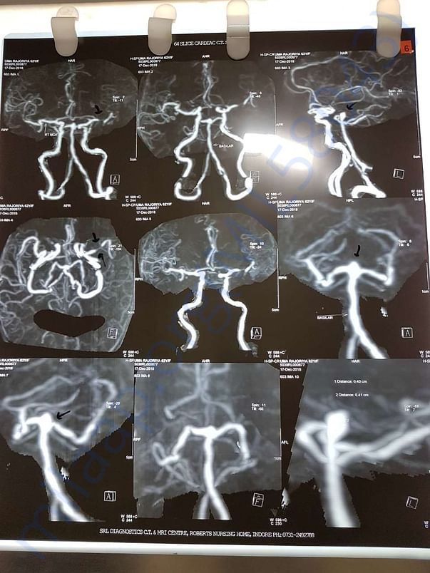 Xray 3