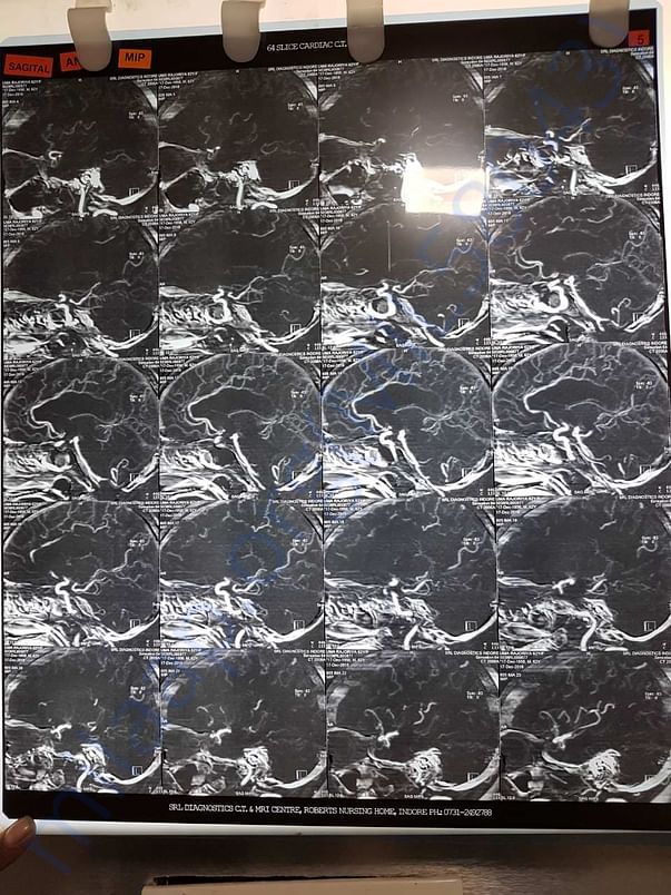 Xray6