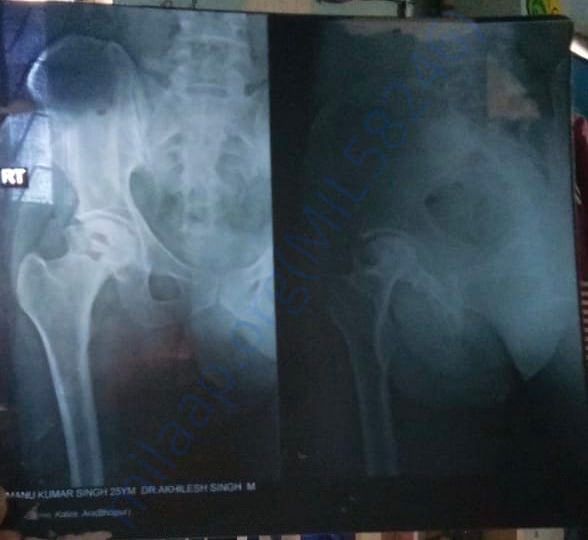 X Ray of Right Hip