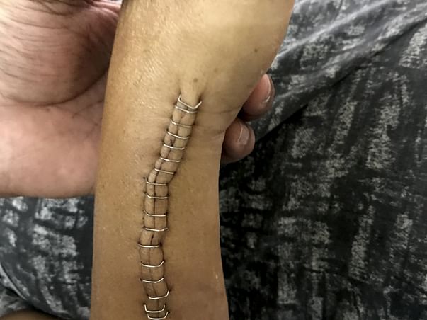 20 years of my nephew is in critical condition due to accident