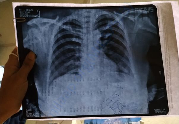 Chest X-ray also done