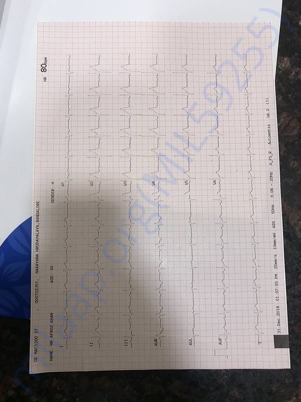 ECG