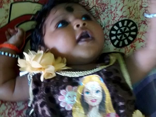 Baby suffering with "Microcephaly "