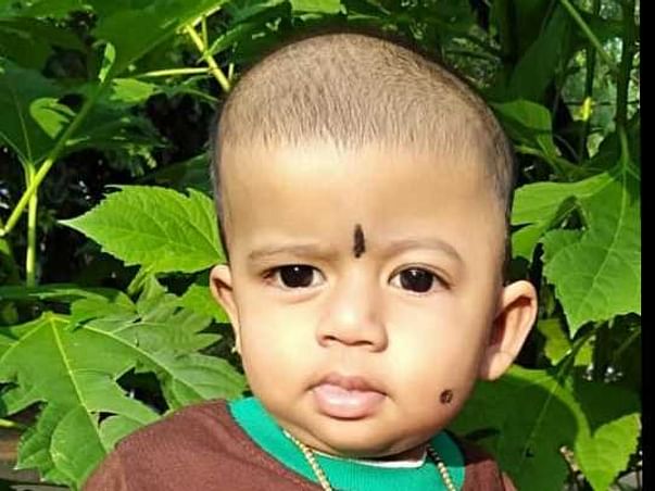 Baby Athira needs Craniosynostosis Treatment. Please help!