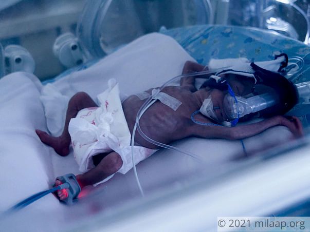 Only 600 Grams At Birth, These Twins Need Help To Survive