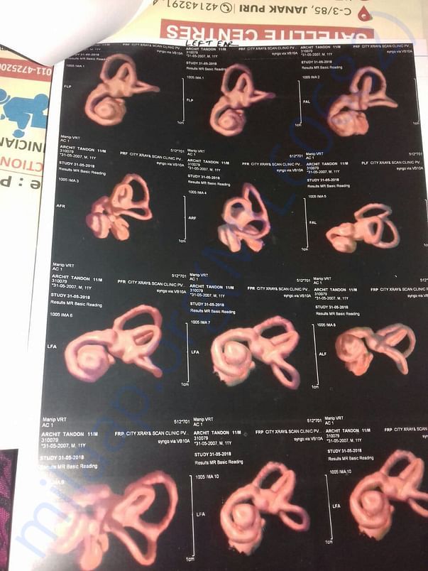 Arshit test regarding Arshit's cochlear implant