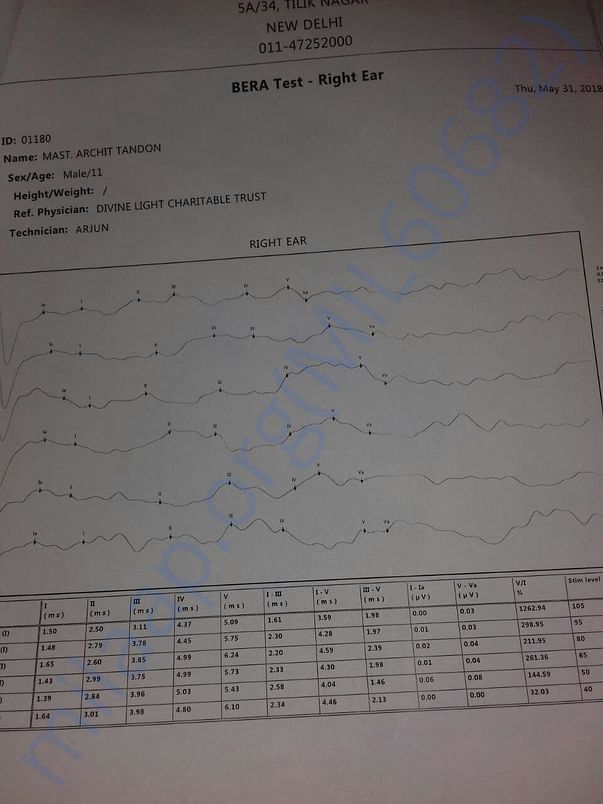 Arshit test regarding Arshit's cochlear implant surgery