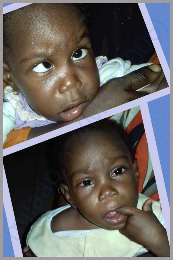 BEFORE & AFTER, MAJOR SQUINT, PREVIOUS VISIT