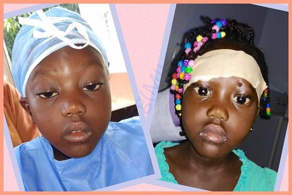 BEFORE & AFTER, DROOPY LIDS, PREVIOUS VISIT