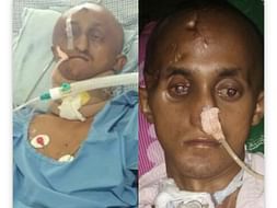 Accident Caused Severe Brain, Throat, Eye Damged. #PleaseHelp
