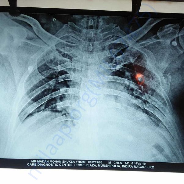 X-Ray Chest