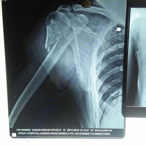 Xray Elbow