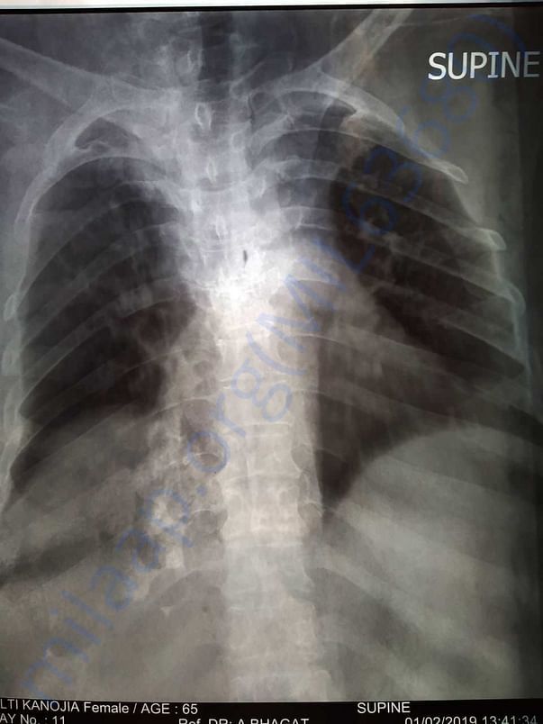 Xray