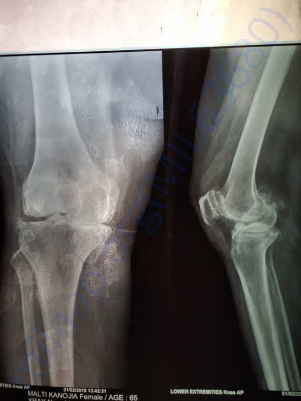 Xray