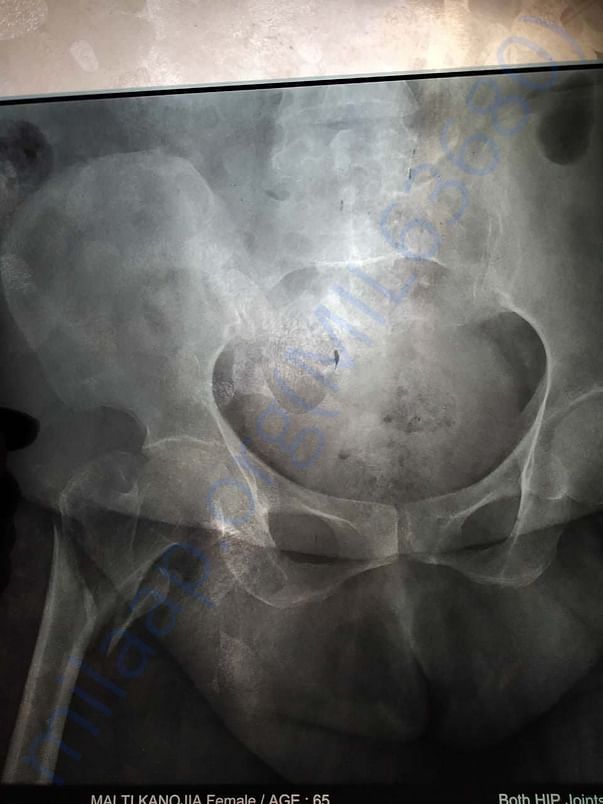 Xray
