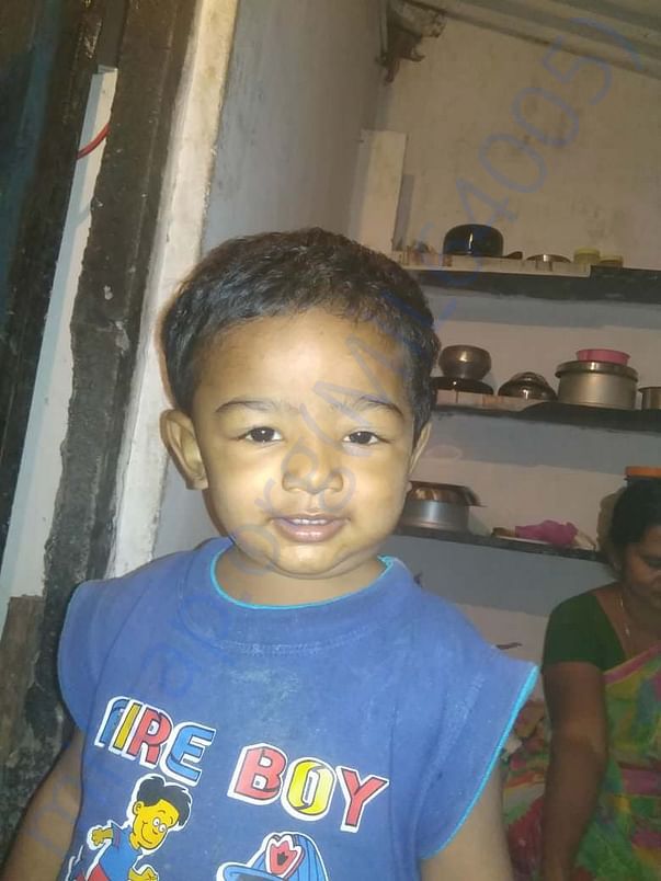 With Nephrotic syndrome