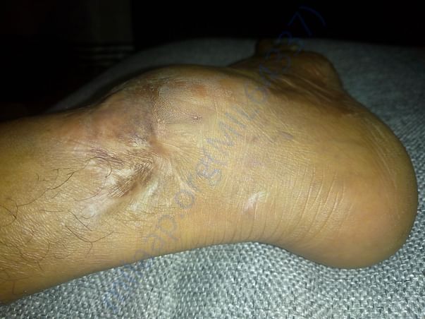 Injuried ankle