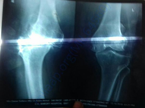 X ray of both knees