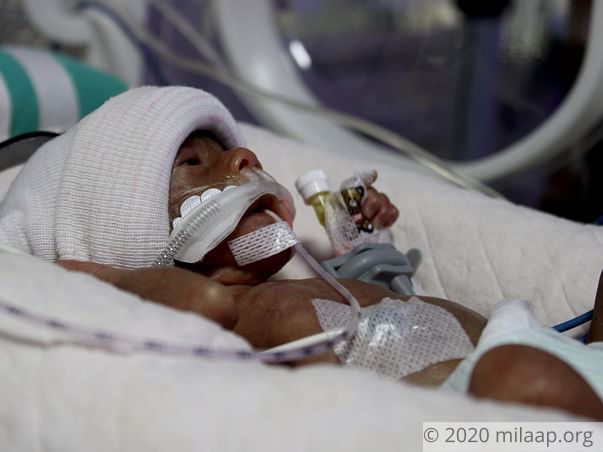 Palm-sized Preemie Fights To Stay Alive While Parents Plead For Help