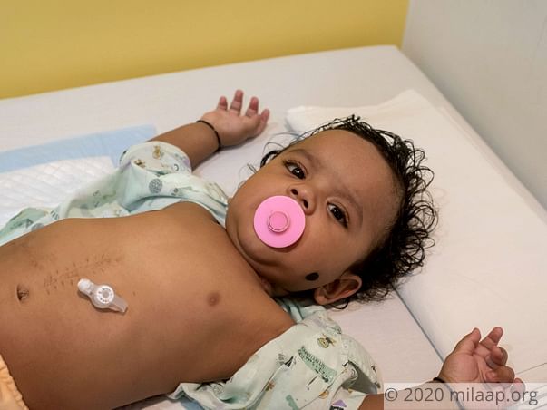 This Baby Who Is Fed Through A Hole In His Stomach Needs Surgery