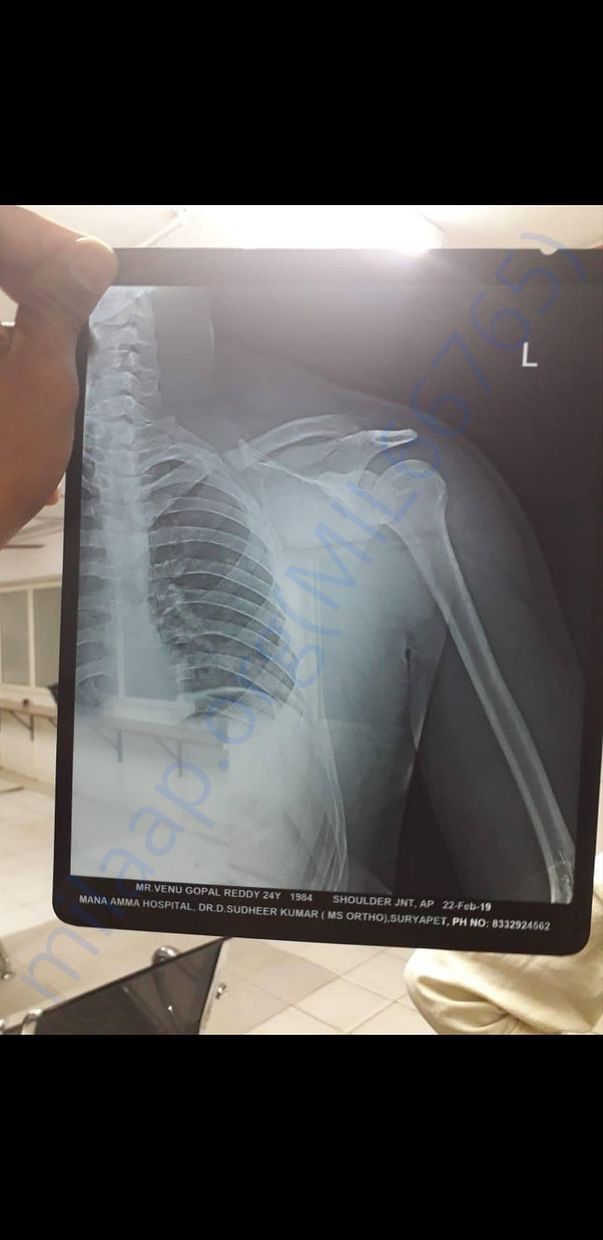 X ray 2