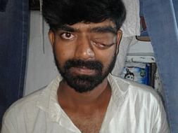 Help Muthyal Rao to Fight against Brain Tumor & Eye fitsula