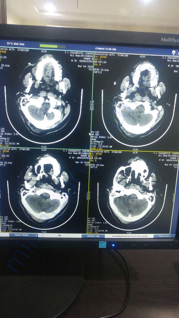 His brain MRI scans after he went into coma
