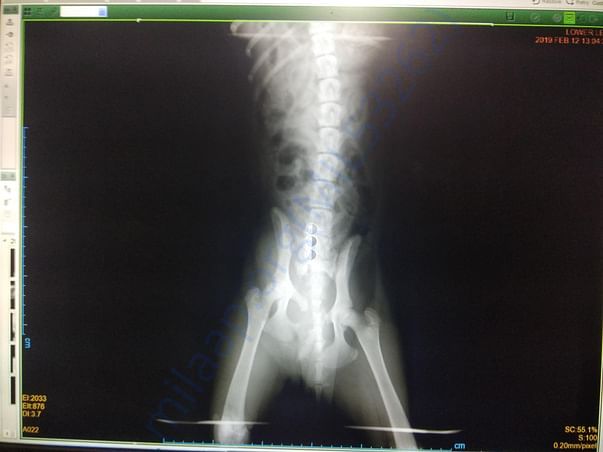X ray showing sacro ilial fracture of the pelvis
