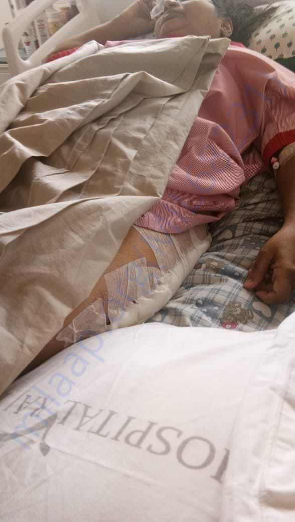 Left leg after operation