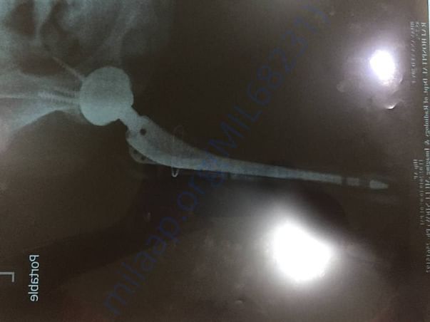 Left leg hip replacement