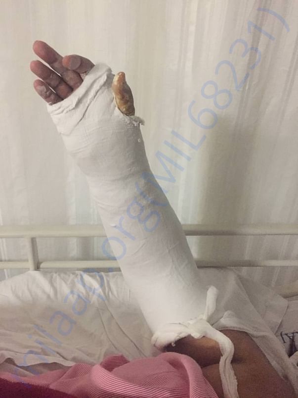 Left hand plaster for support after operation