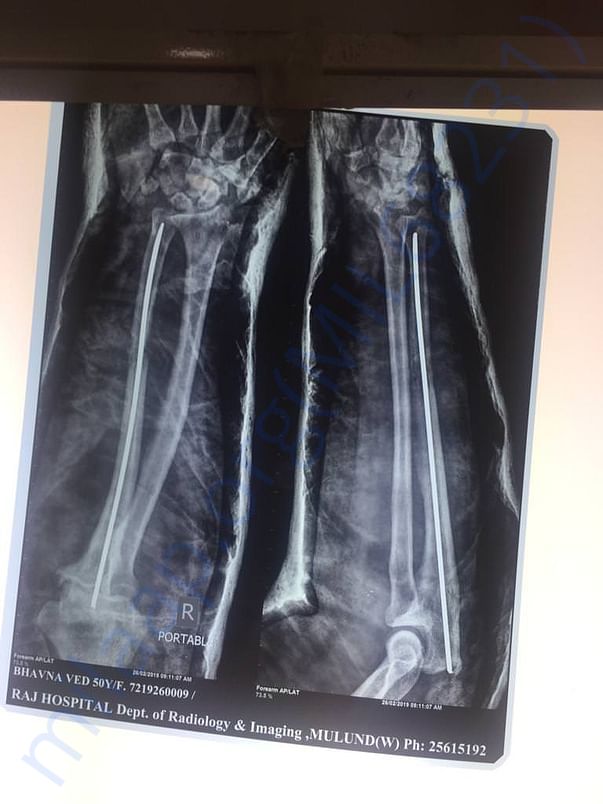 Right leg xray