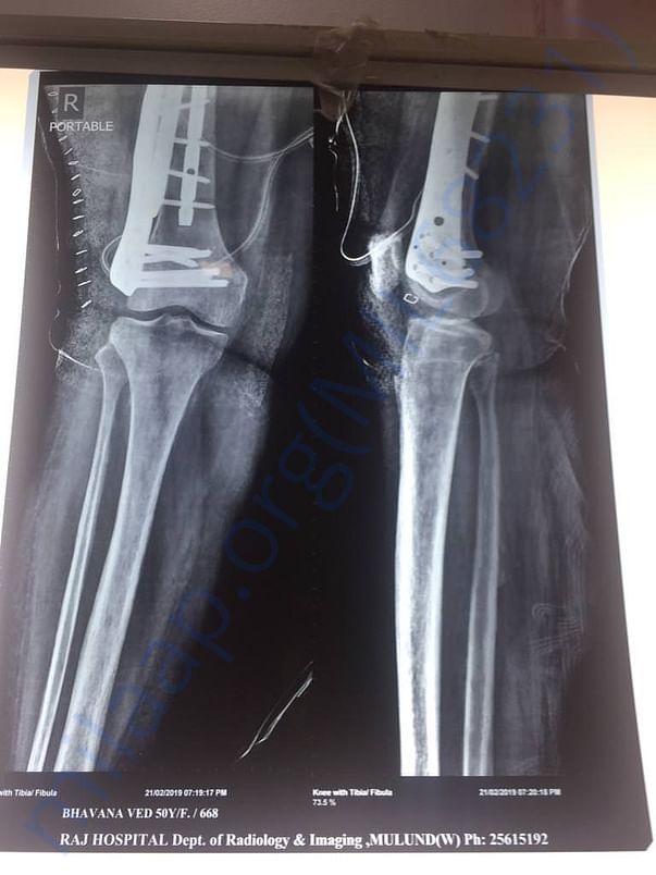 Right leg after operation xray