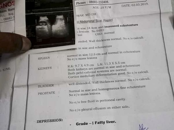 Help Me To Get Treated For Liver Treatment