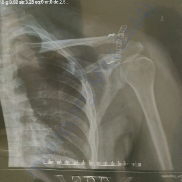 AC dislocation operation