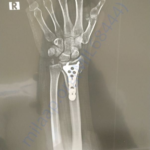 Wrist plate xray
