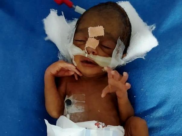 Help Baby Of Rachana Who Was Preterm (30 weeks)