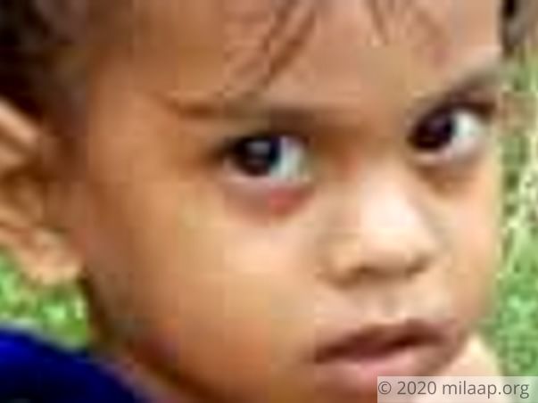 Baby Botta Hema Latha Acute myeloid leukaemia M3