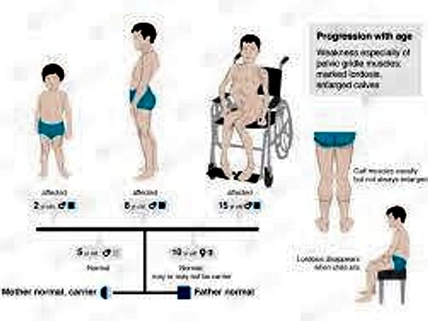 Help Muscular Dystrophy Patients Kindly Donate For The Cause